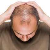 scalp_micropigmentation_danville.